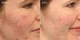 Засіб для вмивання проти прищів Murad Acne Control Clarifying із саліциловою кілотою та екстрактом зеленого чаю Made in USA 200 мл - зображення 11