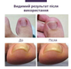 Защитные пластыри для ногтей Elastic Toenail Correction Sticker (50 шт) - изображение 5