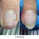 Регенеруюча олія Nails Of The Day ONISTOP проти оніхолізису, 8 мл - зображення 4