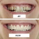 Косметичні накладки на зуби Imako Premium Cosmetic Teeth натуральний білий колір - зображення 7