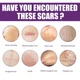 Пластир силіконовий від шрамів та рубців EELHOE Silicone Scar Sheets, гель-пластир від шрамів, тілесний, 4х7,5 см, 4 шт - изображение 3