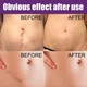 Пластир силіконовий від шрамів та рубців EELHOE Silicone Scar Sheets, гель-пластир від шрамів, тілесний, 4х7,5 см, 4 шт - изображение 5