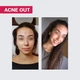 Biotrade (Біотрейд) Acne Out Oxy Wash Cleansing Gel – ніжний гель для вмивання з киснем та молочною кислотою, для жирної та проблемної шкіри обличчя, 200 мл - изображение 2