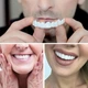 Накладные виниры для зубов InstantSmile, 1 комплект - изображение 8
