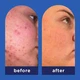 Очищающий эксфолиант с салициловой кислотой Panoxyl Clarifying exfoliant - изображение 4