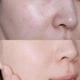 Гиалуроновая сыворотка SKIN1004 Madagascar Centella Hyalu-Cica Blue Serum с центеллой азиатской 30 мл - изображение 6