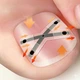 Коректор врослого нігтя X-подібний, нікелевий сплав Ingrown Toenail Correction Kit, Розмір 17 мм - изображение 2