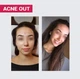 Гель для вмивання Biotrade Acne Out Oxy Wash — з киснем та молочною кислотою, 200 мл - зображення 2