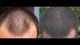 Лосьйон Kirkland для росту волосся Minoxidil 5% (6 шт. по 60 мл) - зображення 4