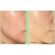 Пилинг-сборка для общения со спикулами и центелою Medipeel Phyto Cica-Nol B5 6000 Shot Serum - изображение 3