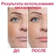 Дермароллер ZGTS с титановыми иглами 0,5 мм с пластиковым тубусом - изображение 7
