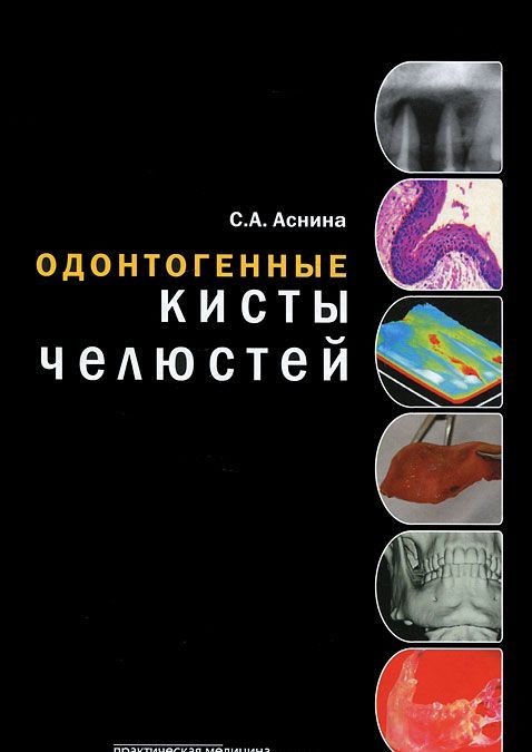 

Одонтогенные кисты челюстей