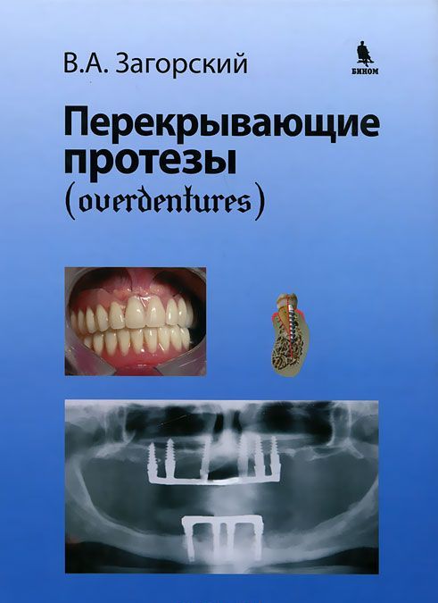

Перекрывающие протезы. (overdentures)