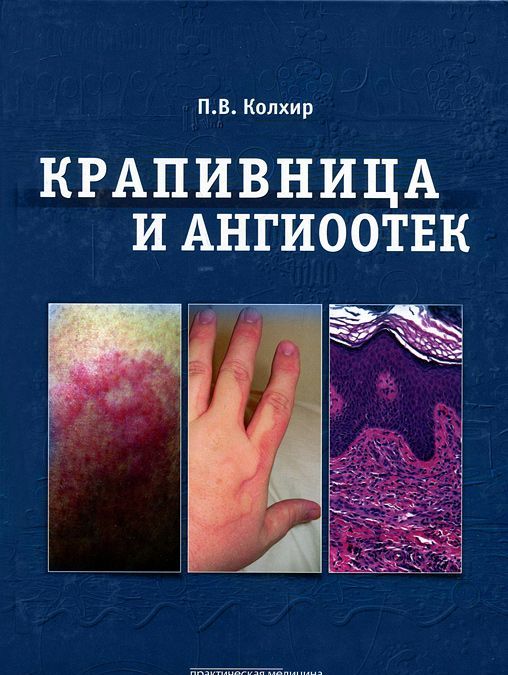 

Крапивница и ангиоотек. Колхир П.В.