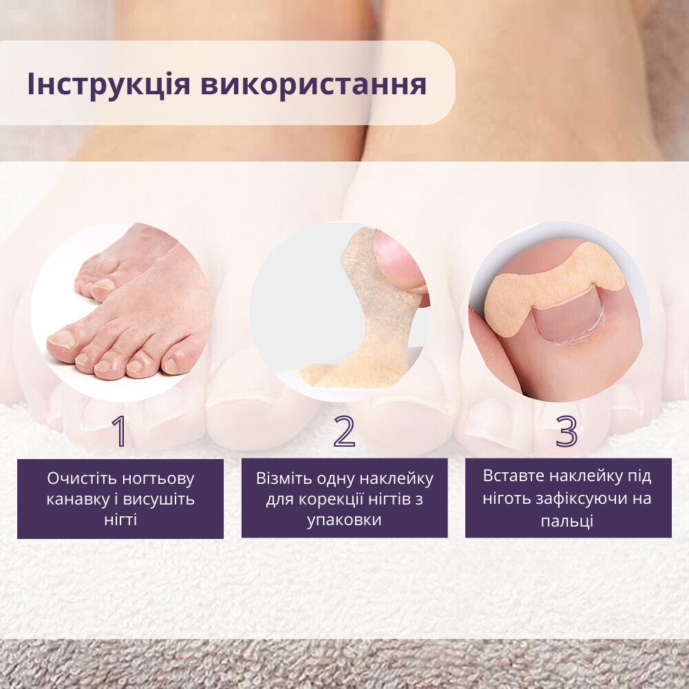 Набор пластырей Elastic Toenail Correction Sticker для безболезненной  коррекции вросших ногтей (50 шт.) от продавца: Tweezy – в интернет-магазине  ROZETKA | Купить в Украине: Киеве, Харькове, Днепре, Одессе, Запорожье,  Львове