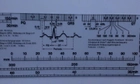 Кардіологічна лінійка для аналізу електрокардіограми ЕКГ (mpm_00088) - зображення 6