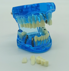Стоматологічна модель із зубами карієсом імплантом періодонтитом каменем колір синій - зображення 3