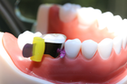 Стоматологічні матриці для жувальної групи зубів 50шт Super Mat - изображение 4