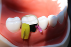 Стоматологічні матриці для жувальної групи зубів 50шт Super Mat - изображение 5
