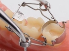 BESTSELLER Набор из 25 зубных матриц Walser® с щипцами и лотком для стерилизации. - изображение 4
