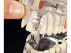 Стоматологическая модель с зубами, кариесом, имплантом, периодонтитом, камнем - изображение 5