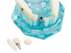 Стоматологическая модель с зубами, кариесом, имплантом, периодонтитом, камнем - изображение 7