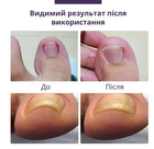 Набір пластирів для нігтів Elastic Toenail Correction Sticker (50 шт) - зображення 5
